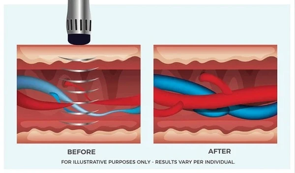 Mechanism of extracorporeal shock wave therapy Mechanism of extracorporeal shock wave therapy